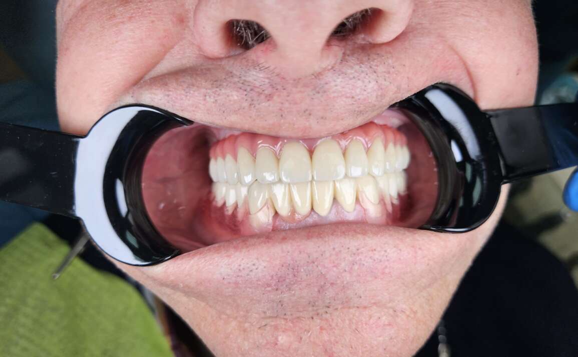 Restaurare totală complexă zirconiu pe 4 implante