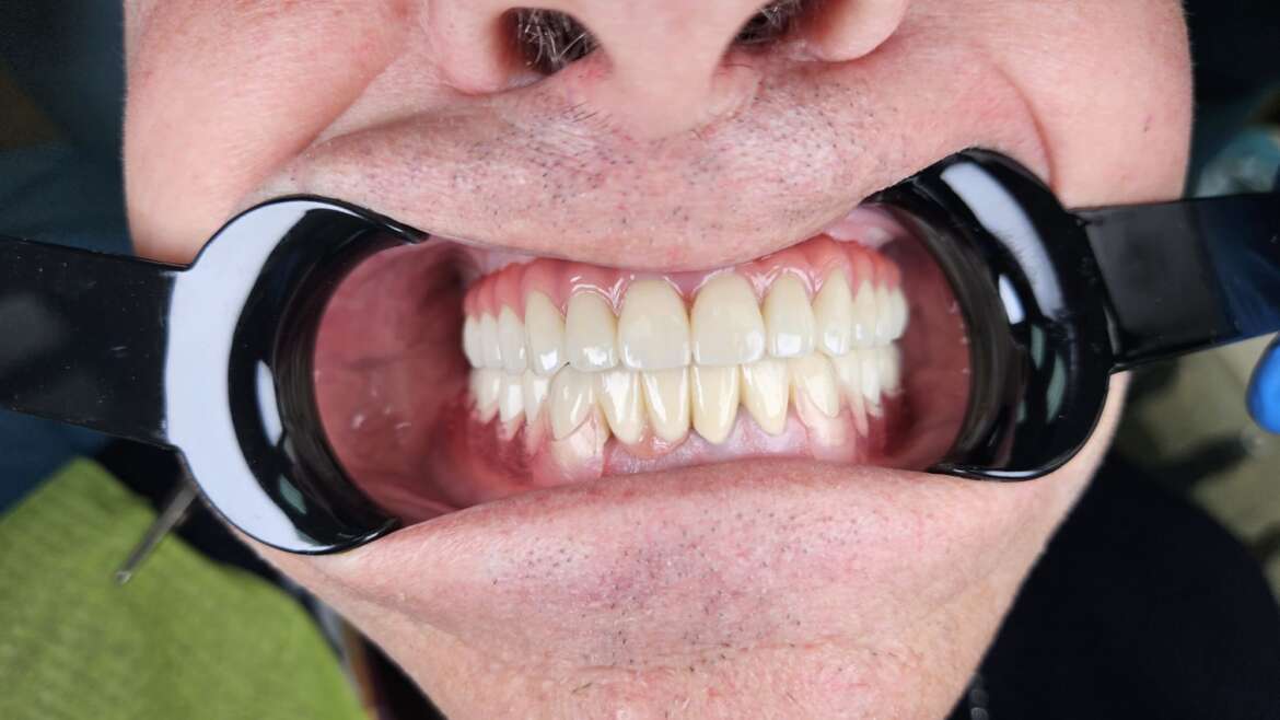 Restaurare totală complexă zirconiu pe 4 implante
