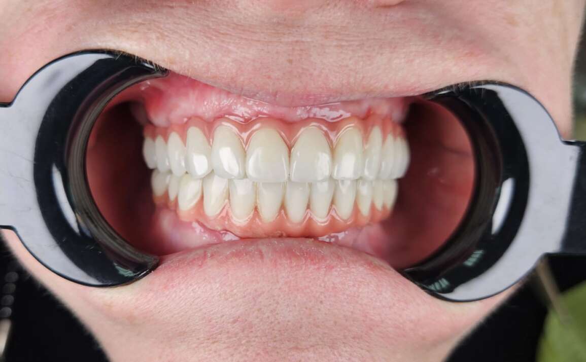 Protezare totală pe implante (partea superioară all-6 zirconiu, partea inferioară all-4 zirconiu)