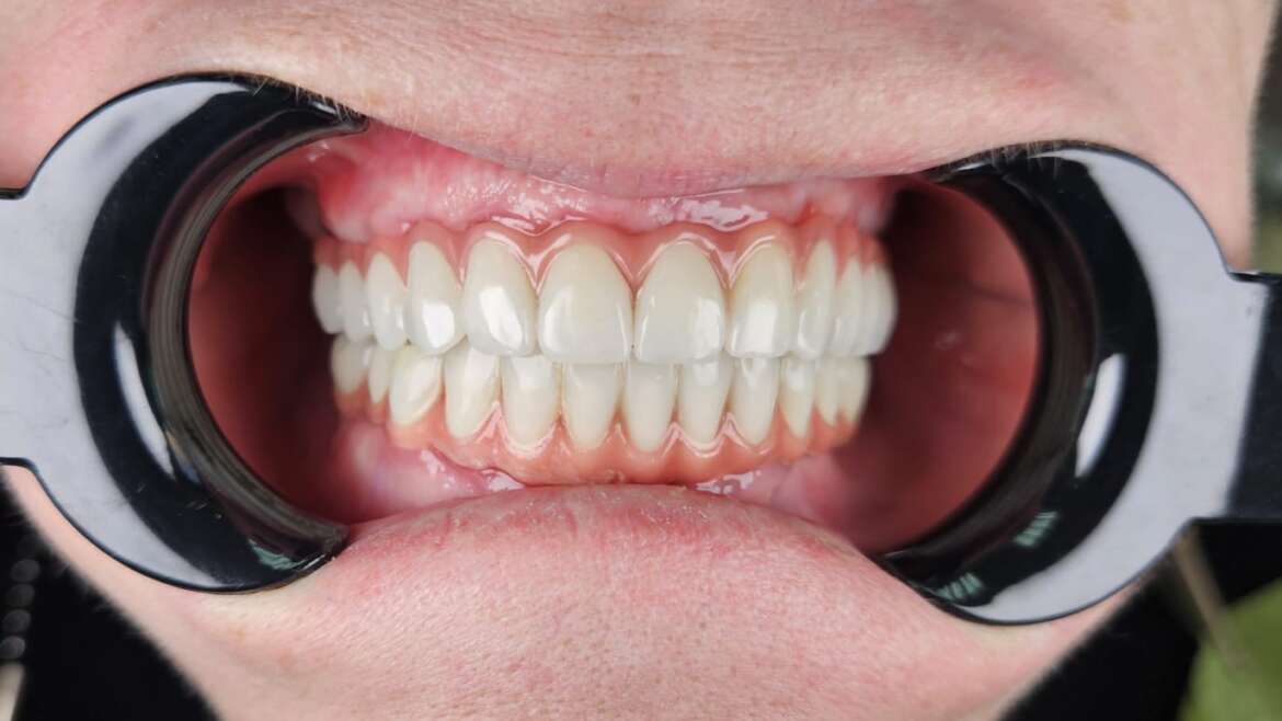 Protezare totală pe implante (partea superioară all-6 zirconiu, partea inferioară all-4 zirconiu)